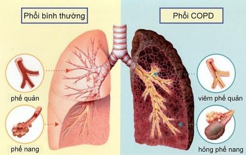 Hình ảnh phổi bình thường và phổi bị COPD